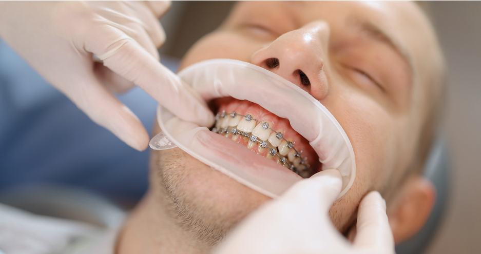 Braces Cost  Sydney CBD Dentistry